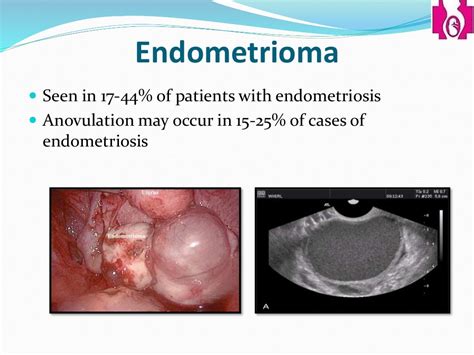 laparoscopic fulguration of endometriosis